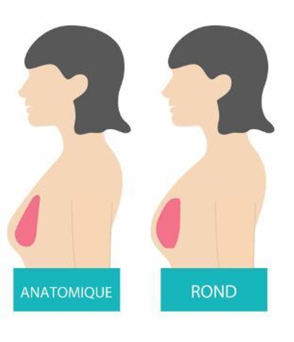 implants mammaires anatomiques ou ronds