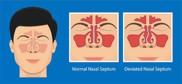 Déviation de la cloison nasale 