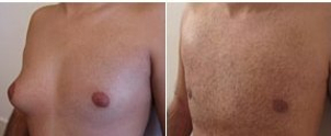avant / après d'une gynécomastie