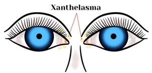 Xanthélasma