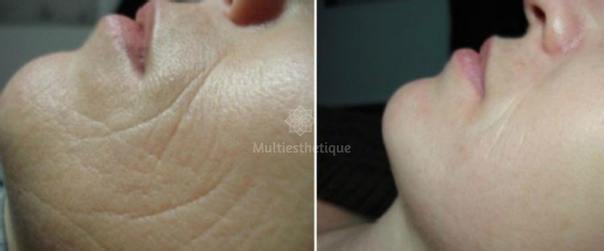 Risques possibles microdermabrasion