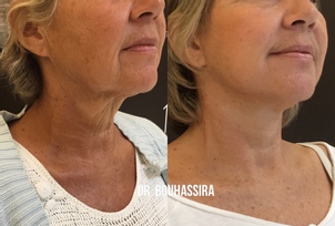 traitement anti rides avant après