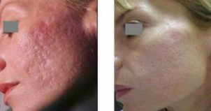 laser dermatologique avant apres