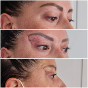 fils tenseurs avant / après