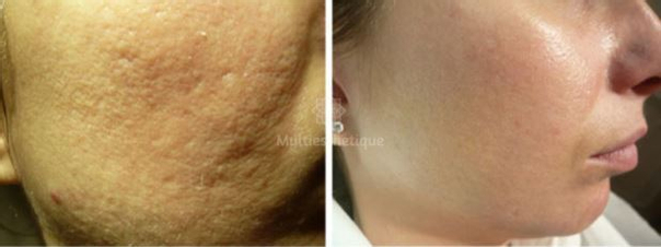 avant / après traitement anti acné