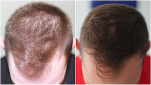 calvitie avant / après