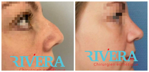 avant / après rhinoplastie