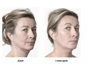Photorajeunissement avant/après