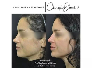 Injections d'acide hyaluronique Dr Desouches