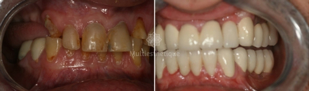implants dentaires avant après 
