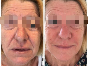 radiofrequence avant après