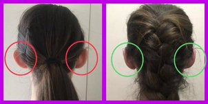 L'otoplastie, pour les déformations de l'oreille