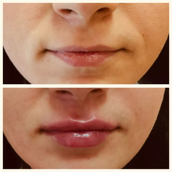 avant / après augmentation des lèvres permalip