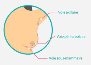 Les voies cicatricielles d'un implant mammaire