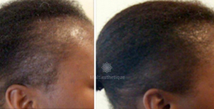 Traitement capillaire