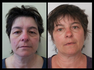 avant / après blépharoplastie