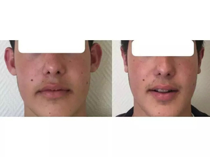 otoplastie avant / après
