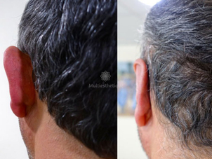 otoplastie avant / après