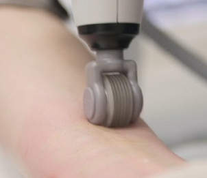 Traitement cicatrice chéloïde