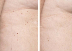 grains de beauté avant après