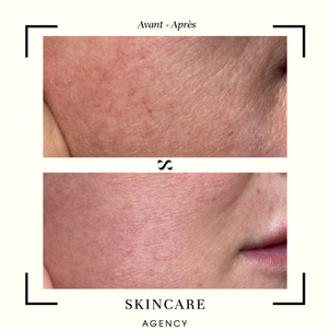 avant / après laser dermatologique