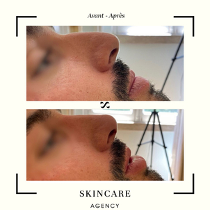 rhinoplastie médicale avant après