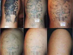 avant / après détatouage