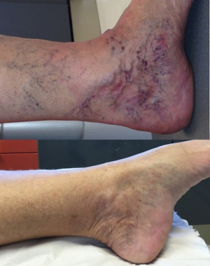 varices avant après