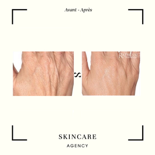 Skinbooster pour les mains