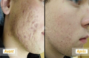 Résultats microdermabrasion