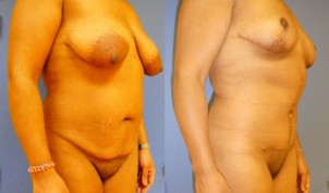 avant / après abdominoplastie