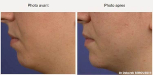 avant / après génioplastie