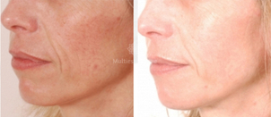 Avant / Après traitement de la rosacée