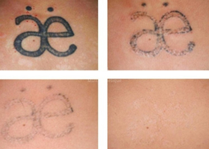 avant / après détatouage