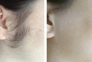 epilation laser avant / après