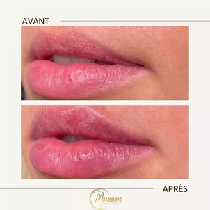 Avant / après augmentation des lèvres par lifting
