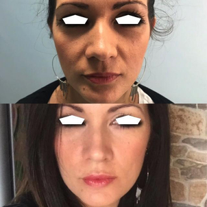 traitement anti rides avant après