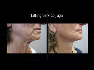 avant / après lifting