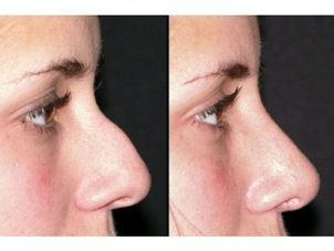 rhinoplastie médicale avant après