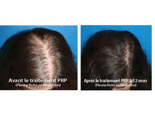 Traitement capillaire PRP