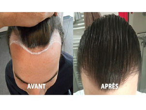 Alopécie ou calvitie chez l'homme