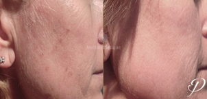 peeling avant / après