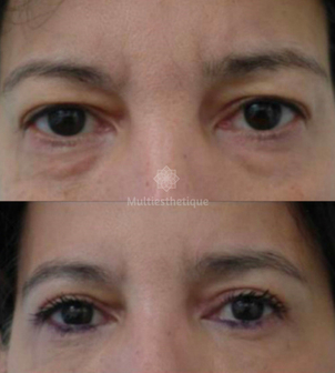 avant / après une blépharoplastie