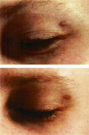 grains de beauté avant après