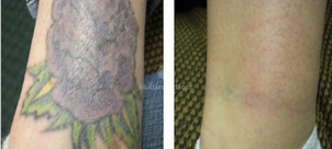 avant / après détatouage