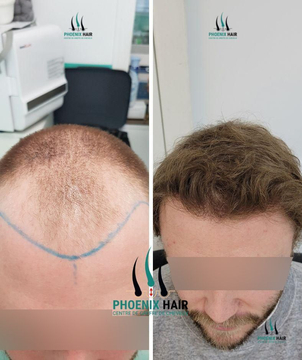 greffe de cheveux avant / après