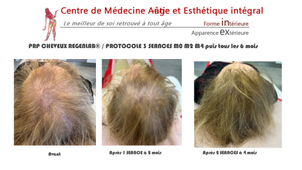 calvitie avant / après