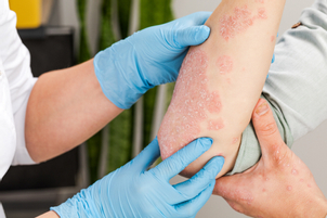En finir avec le psoriasis : quels traitements ?