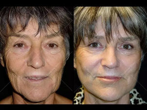 avant / après lifting