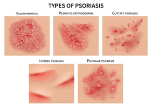 Psoriasis